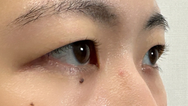 手术前的状态 其一