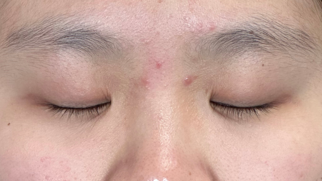 手术前的状态 其一