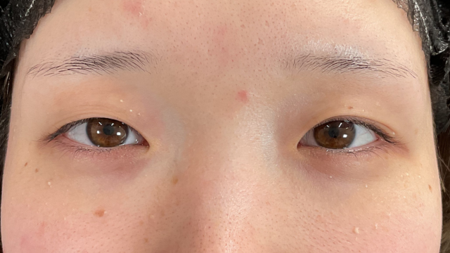 手術前の状態 その1