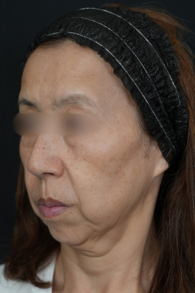 手術前の状態 その1