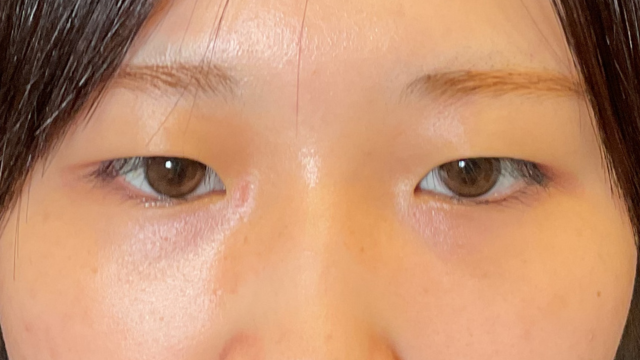 手术前的状态 其一