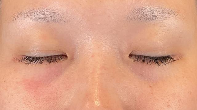 Postoperative Condition Part 1