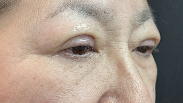 手术前的状态 其一