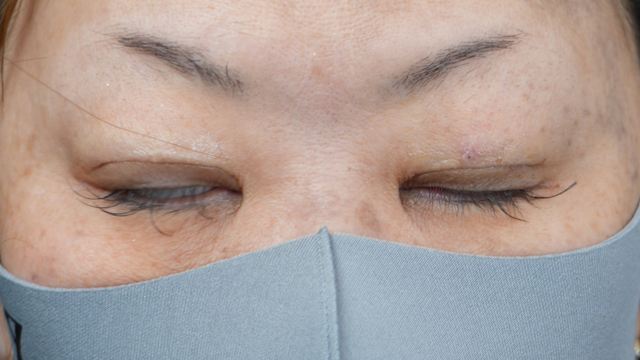 手术前的状态 其一