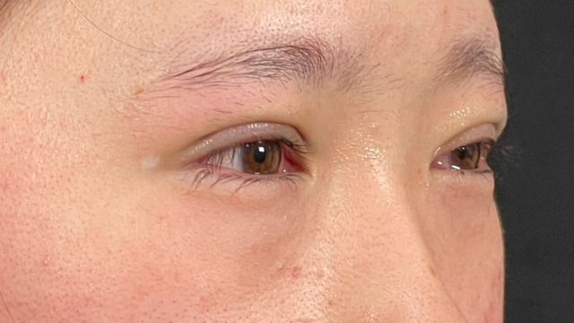 Postoperative Condition Part 1