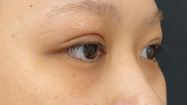 手术前的状态 其一