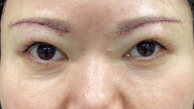 手术前的状态 其一