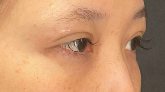 手术前的状态 其一