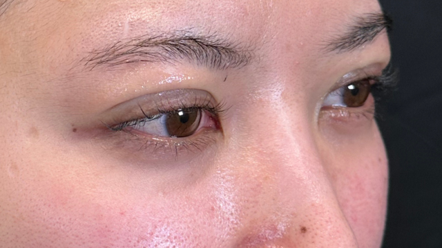 手術前の状態 その1