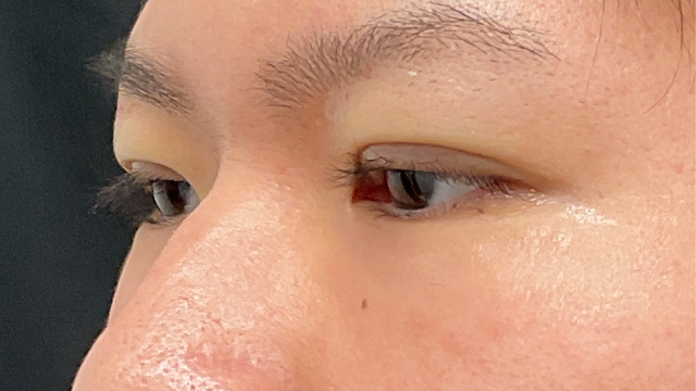 手術前の状態 その1