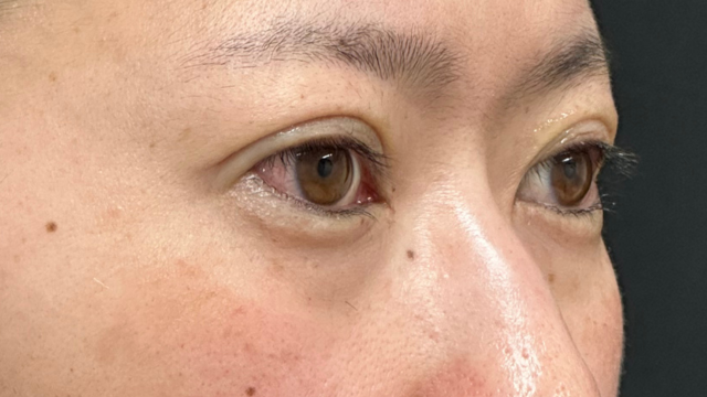 手术前的状态 其一