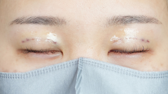 手術前の状態 その1