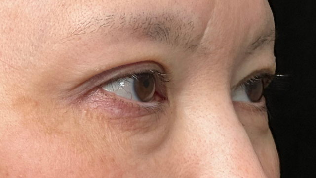 手术前的状态 其一