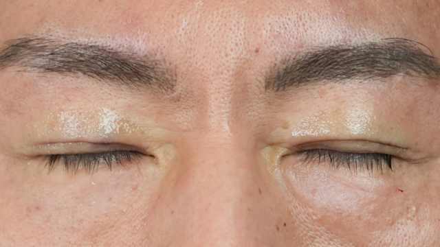 手术前的状态 其一