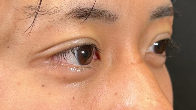 手术前的状态 其一