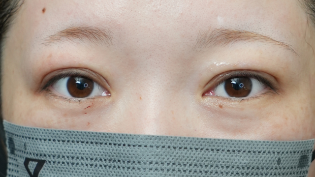 手术前的状态 其一