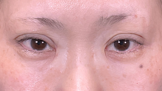 手术前的状态 其一