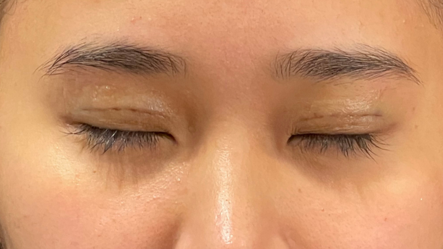 手術前の状態 その1