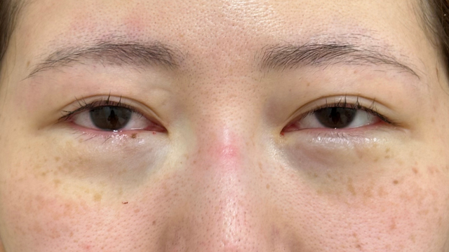 手术前的状态 其一