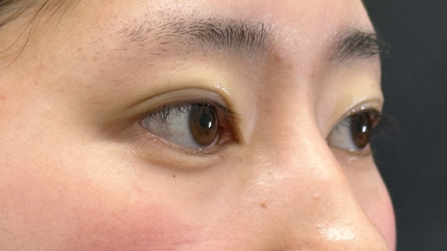 手術前の状態 その1