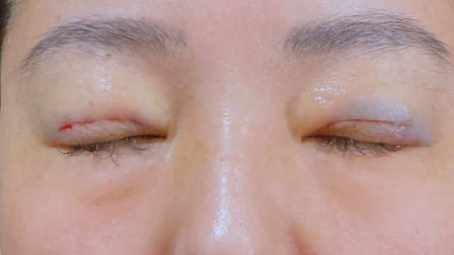 手術前の状態 その1