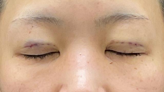 手术前的状态 其一