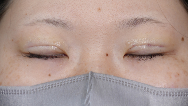 手术前的状态 其一