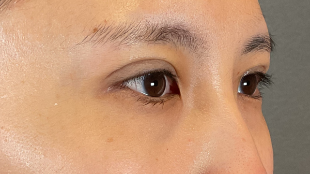 手術前の状態 その1