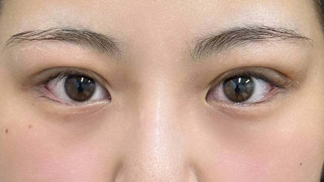 手術前の状態 その1