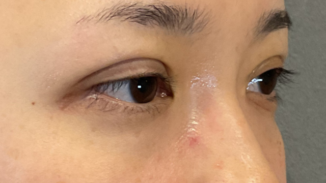 手术前的状态 其一