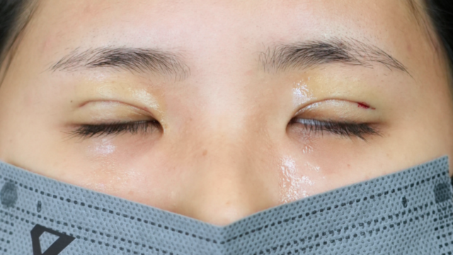 手术前的状态 其一