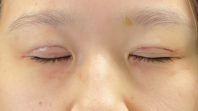 手术前的状态 其一