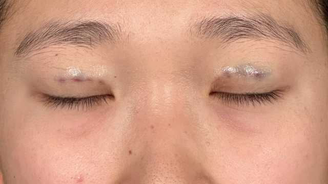 手術前の状態 その1