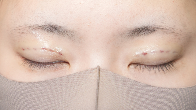 手术前的状态 其一