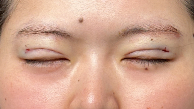 手术前的状态 其一