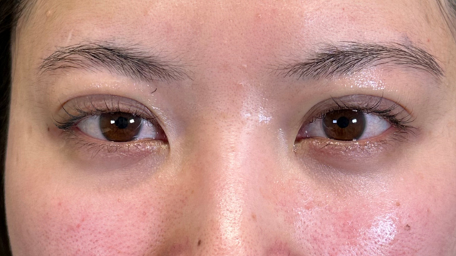 手術前の状態 その1