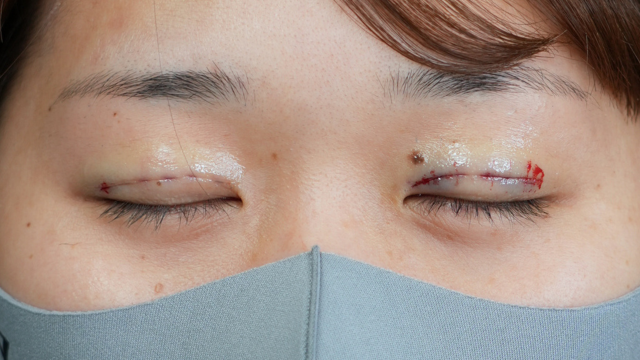 手術前の状態 その1