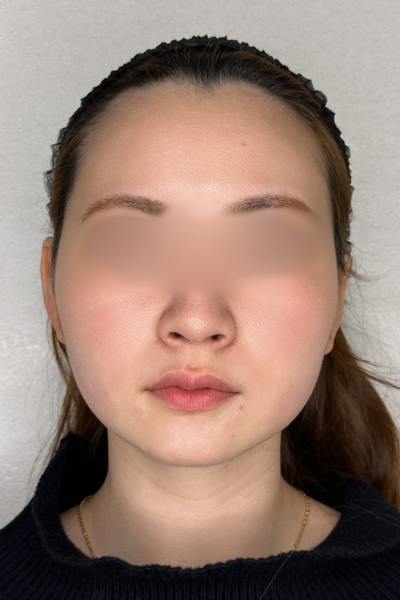 手術前の状態 その1