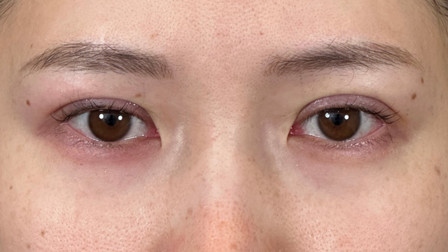 手术前的状态 其一