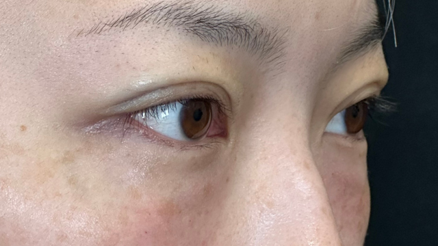 手术前的状态 其一