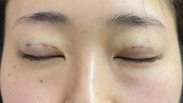 手术前的状态 其一