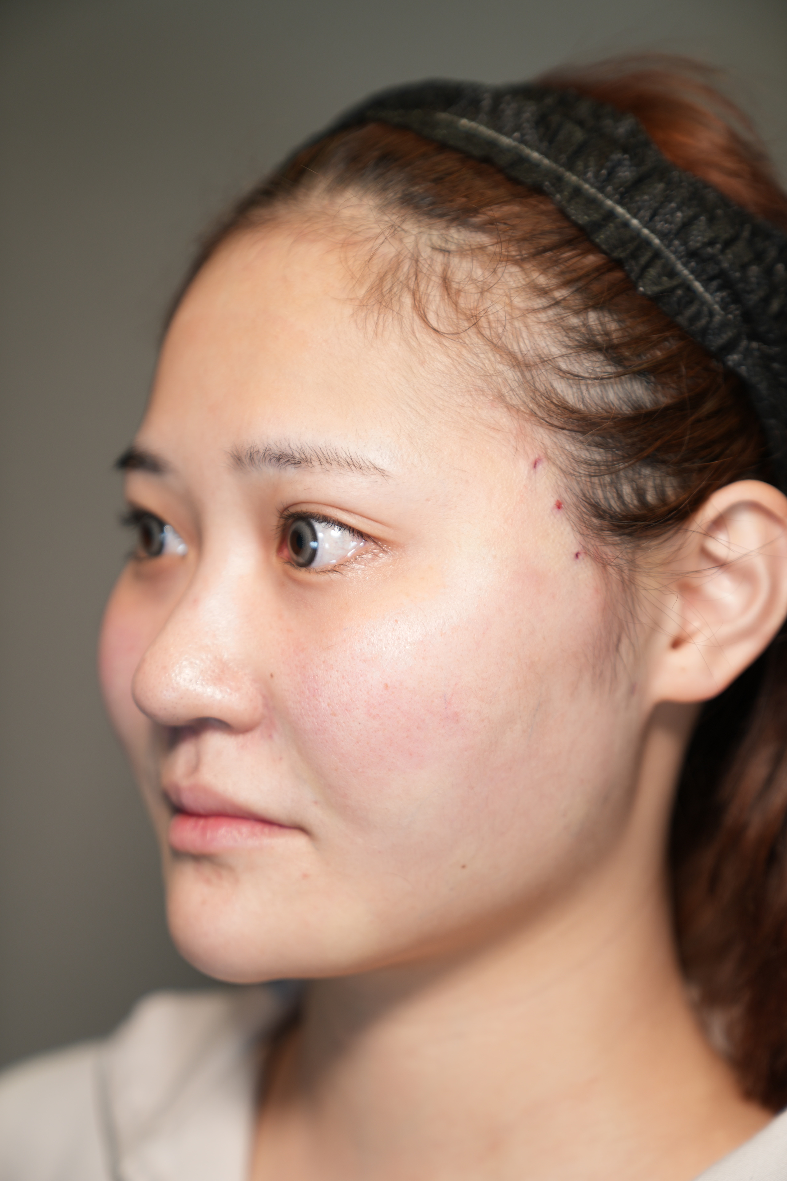 手术前的状态 其一