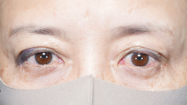 手術前の状態 その1