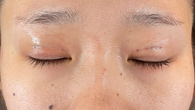 手术前的状态 其一