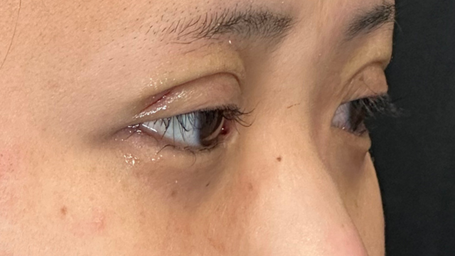 手术前的状态 其一