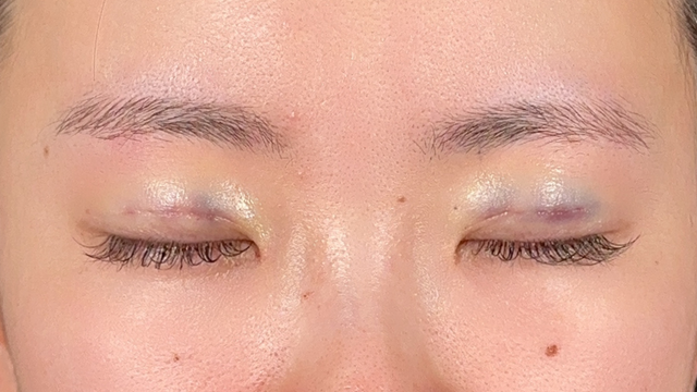 Postoperative Condition Part 1