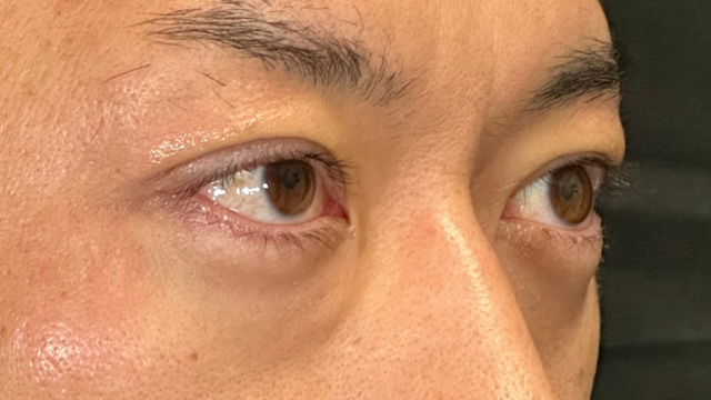 手术前的状态 其一