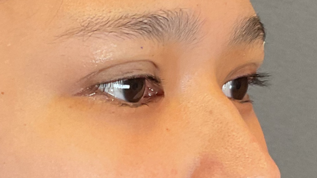 手術前の状態 その1