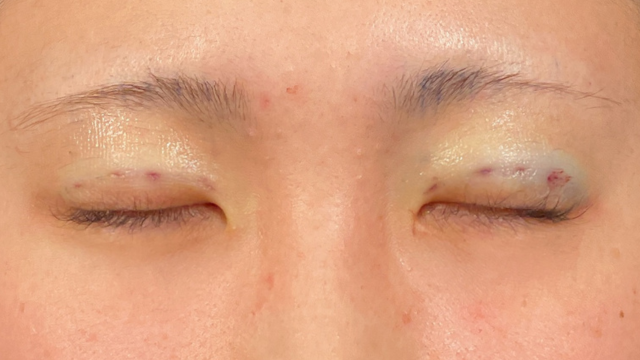 手术前的状态 其一