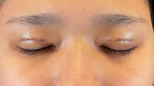 手術前の状態 その1